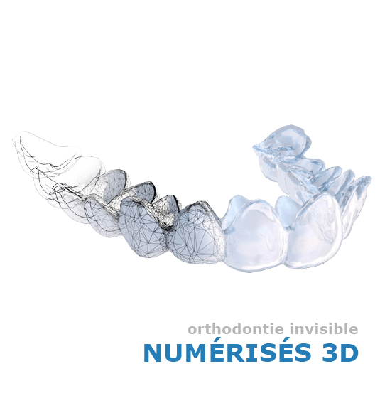 Gouttière d'alignement dentaire Uzège Ortho 3D à Nîmes